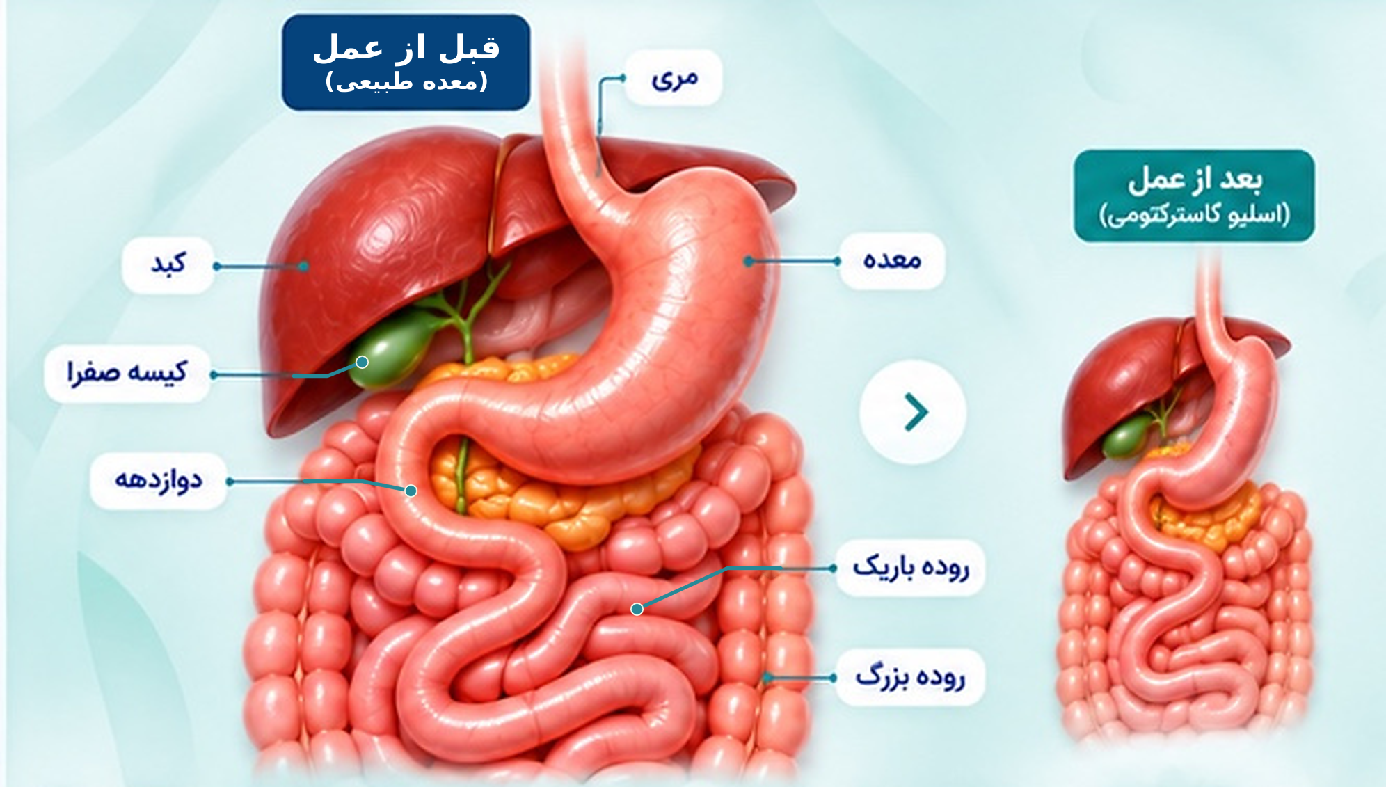 آناتومی تأییدشده جراحی اسلیو معده